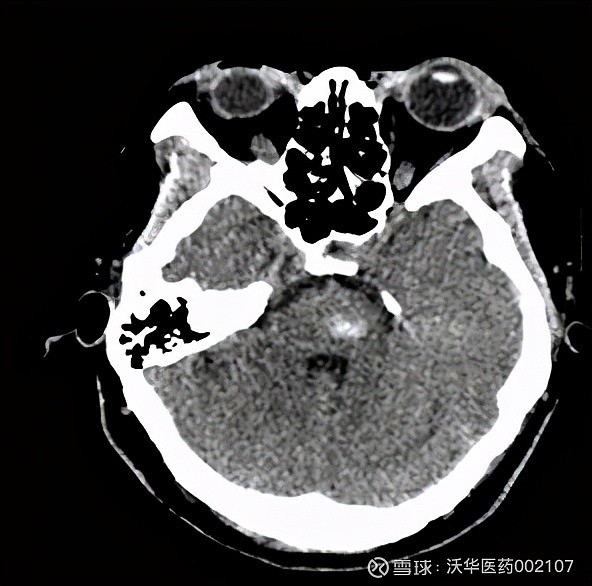 脑干出血ct图片