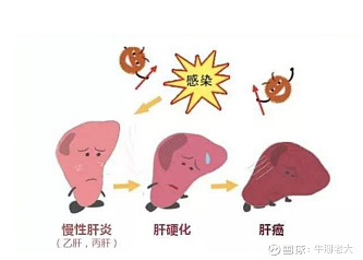 治疗丙肝请认准正版吉三代不要买错仿制药