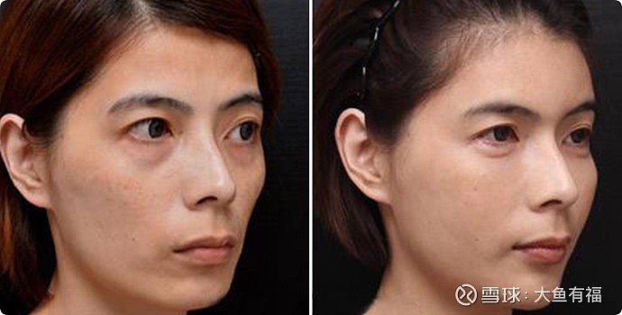 华东医药sz000963新氧发的伊妍仕少女针效果前后对比照