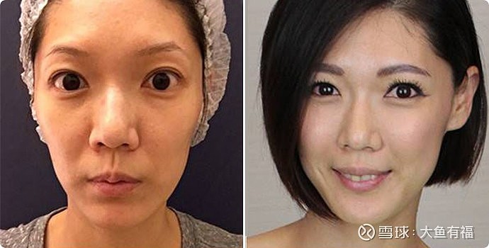 华东医药sz000963新氧发的伊妍仕少女针效果前后对比照