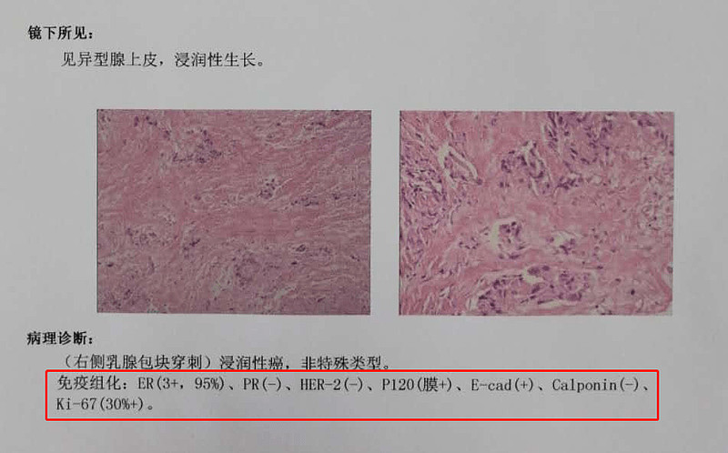 也就是下面的幾個英文縮寫:3,病理檢查免疫組化指標原位癌是癌症最輕