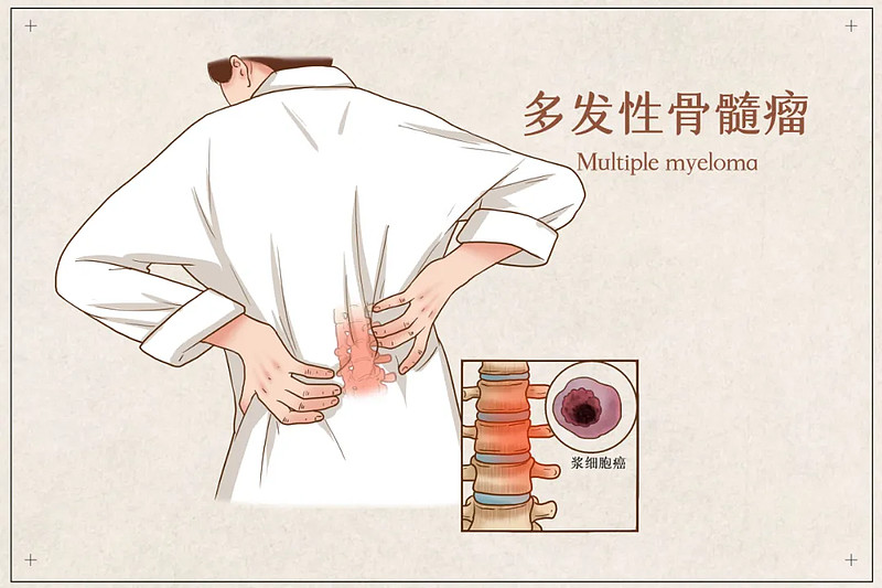 多发性骨髓瘤(mm)是一种浆细胞恶性疾病,特征是单克隆浆细胞恶性增殖