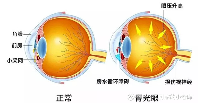 青光眼是指由于病理性眼内压升高导致视神经损伤,视野缺损使视力逐渐