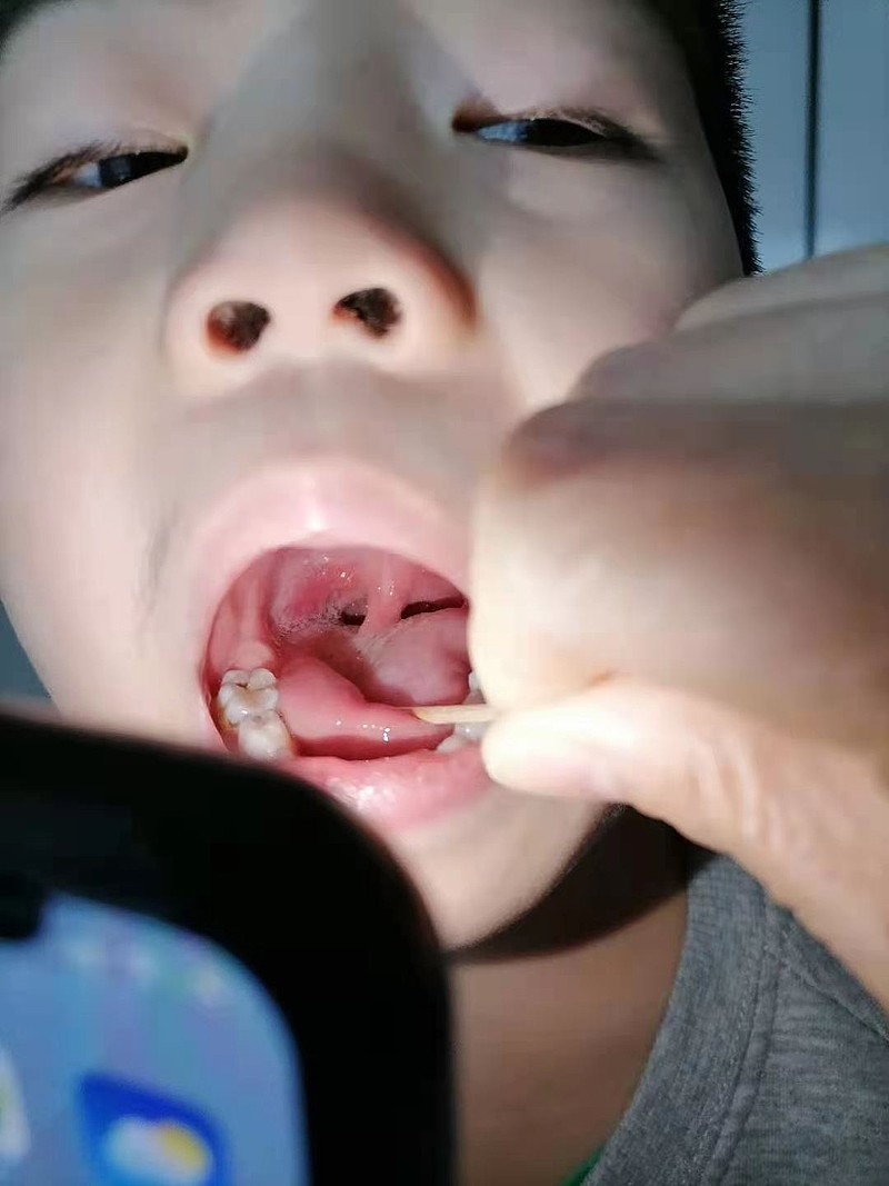 小孩子的喉咙图片清晰图片