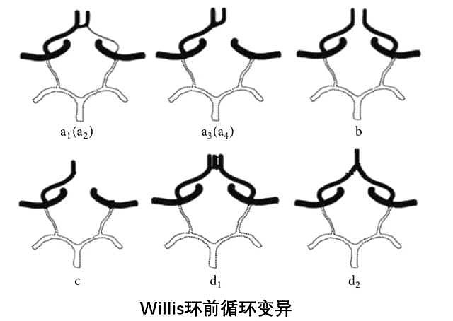 willis環可以減弱頸內動脈系統和椎基底動脈系統內壓力和流量的正常