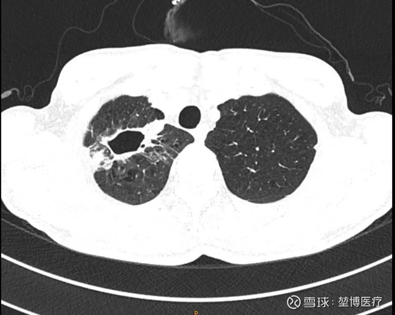 肺癌微創治療最新進展經支氣管鏡下肺部腫瘤射頻消融治療案例分享轉發