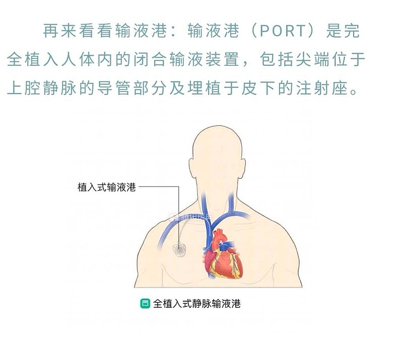 静脉输液如何排气图解图片