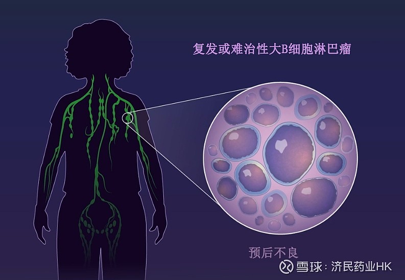 Breyanzi(liso-cel)在日申请用于二线治疗大B细胞淋巴瘤 百时美施贵宝 公司(Bristol-Myers Squibb)于3月 ...