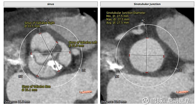 经典病例周周谈丨珠海市人民医院姜小飞主任团队完成一