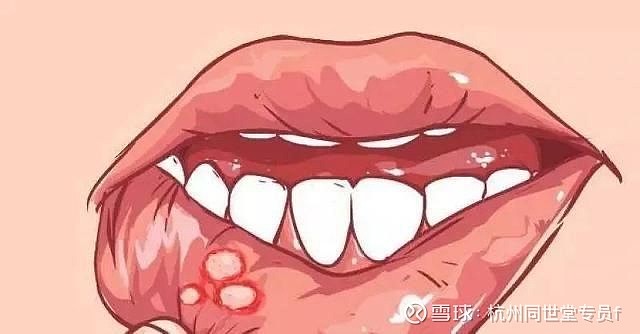 腮帮里面溃疡发白图片图片