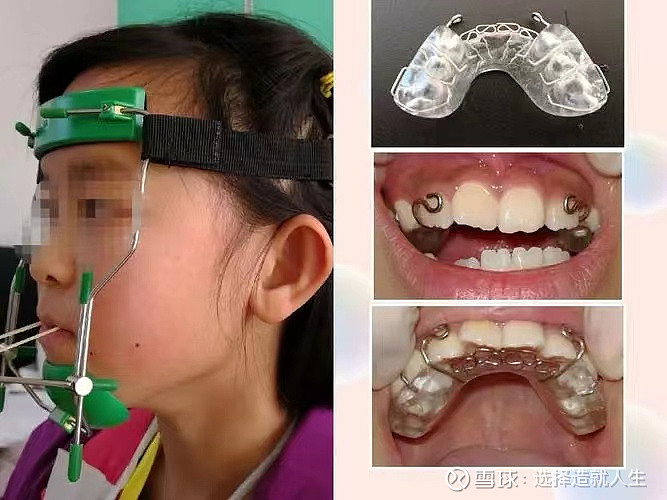 医生a:尝试前方牵引(上颌少量扩弓,后牙覆盖不一定能达到正常),治疗