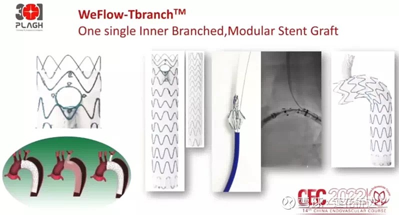 Cec 2022｜郭伟：主动脉系列创新器材多中心临床最新数据解读 2022年12月2号，第14届cec召开，郭伟教授公布了主动脉创新器械的临床进展（转载，学习用） 腔内器材和技术的创新和