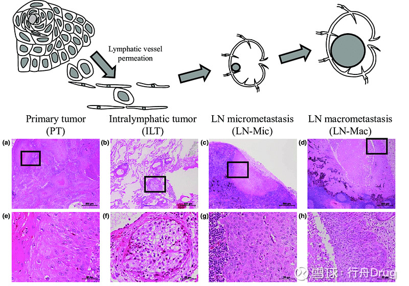 病理学:肿瘤 点击上方的 行舟Drug 添加关注 肿瘤(tumor, neoplasm)是以细胞异常增殖为特点的一大类疾病。 良性... - 雪球