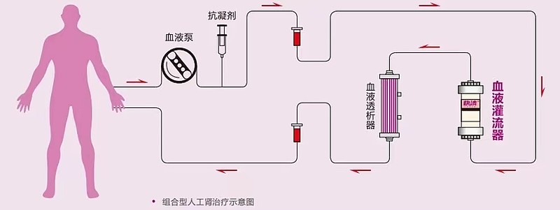 一文说清楚血液灌流 目前医院对于终末期肾病患者（尿毒症患者），采用的标准血液净化方案是：每周3次血液透析，外加每月2次血液滤过，以及每月1次 ...