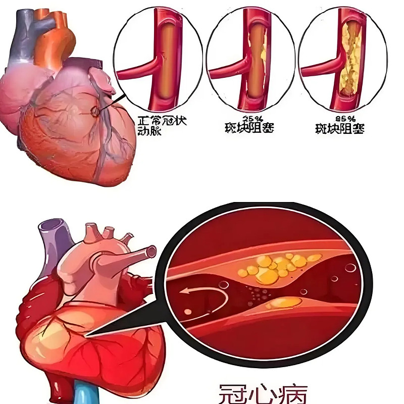 冠状动脉堵塞 xueqiu.com