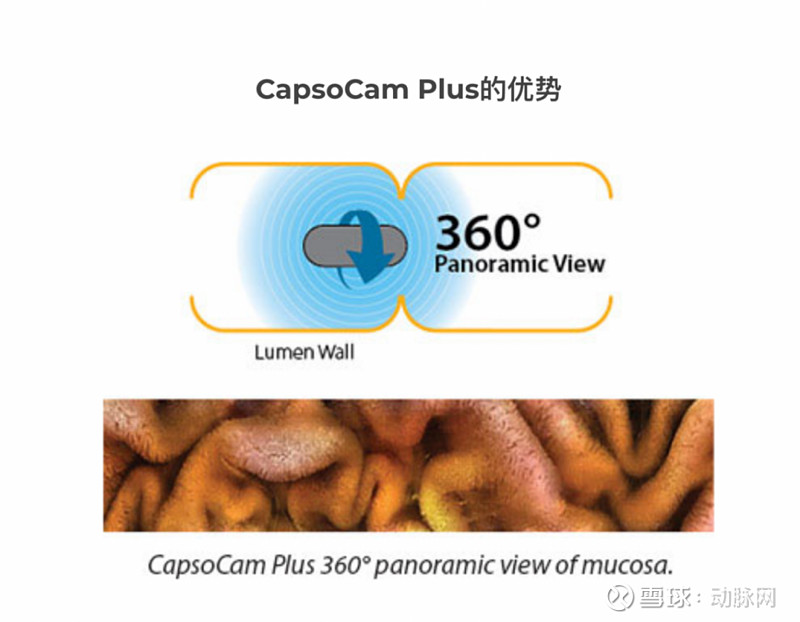 Capsovision 融资超1亿美元,CapsoVision如何成为儿科患者市场的胶囊内镜领跑者? 2025年1月, CapsoVision 连续斩获两项FDA里程 ...